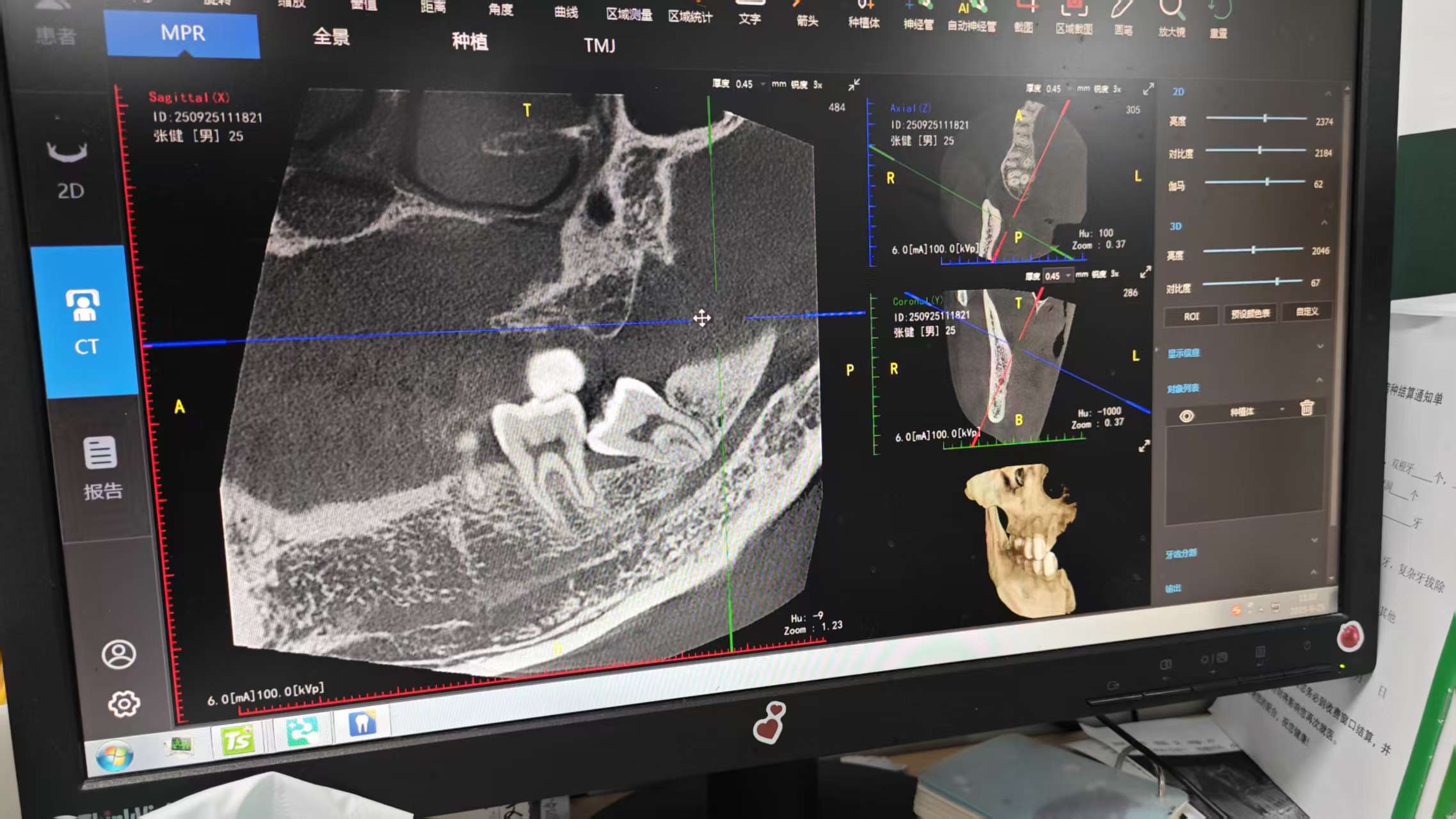 折磨人的智齿，终于拔掉了，谈一下我的感受。 | 艾自由网 | ifree6.cn